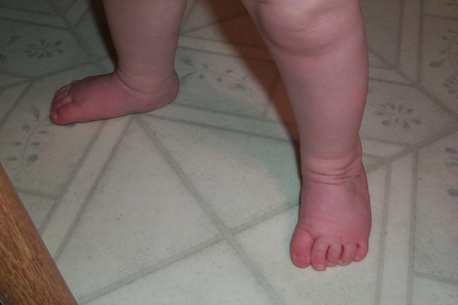 Kelly's feet 3 months after tenotomy